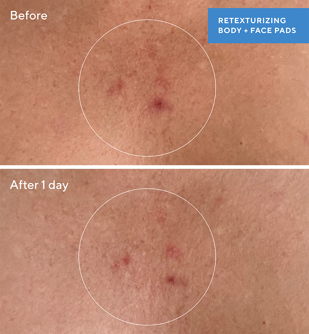 Retexturizing Body Pads - Image 3